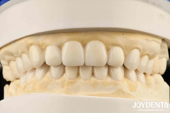 kopen Diagnostische Wax-Up van Veneers voor Tandheelkundige Biomimetische Esthetiek online vervaardiging