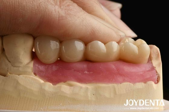 kopen Ultra-precieze verwerking Zirconia-implantaten met AI-geassisteerd ontwerp en Bionische tandvleespiercing voor een geintegreerde kroon van geheel zirconium online vervaardiging