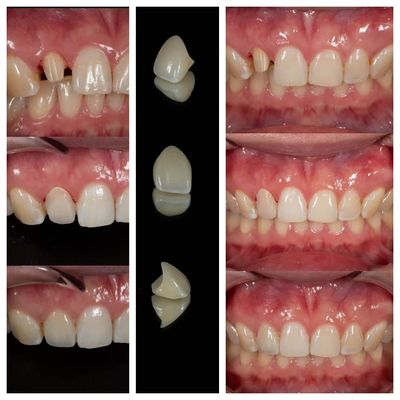 kopen Zirconia tandheelkundige kronen fabricage lab. Precision Crown Outsourcing - Joydentalab online vervaardiging