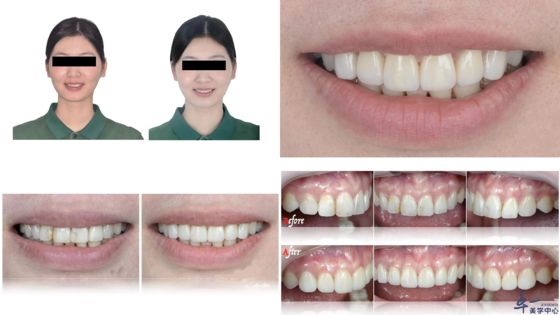 kopen De populaire producten van Joydentalab: gesimuleerde esthetische fineer online vervaardiging