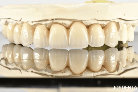 kopen Revolutionize Aesthetics & Strength: Introducing Our Multi-Layered Chromatic Zirconia Bridge online vervaardiging