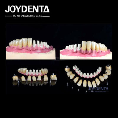 kopen Meerdere endosese tandheelkundige implantaten Interne verbinding voor volledige boogherstel online vervaardiging