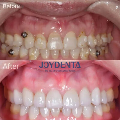 kopen Tandheelkundige veneers voor ontbrekende tanden. Global Premium Dental Lab Services online vervaardiging