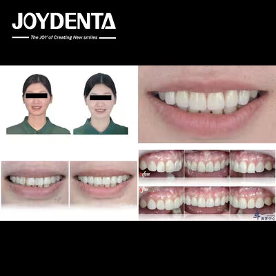 kopen De populaire producten van Joydentalab: gesimuleerde esthetische fineer online vervaardiging