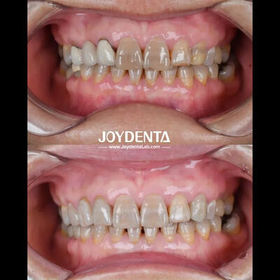 kopen Lichte tandheelkundige zirconia voor een optimale patiëntbeleving Natuurlijke kleur online vervaardiging