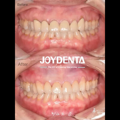 kopen Tandheelkundig Zirkoniumoxide voor Veilig Oraal Weefsel en CAD/CAM-compatibiliteit online vervaardiging