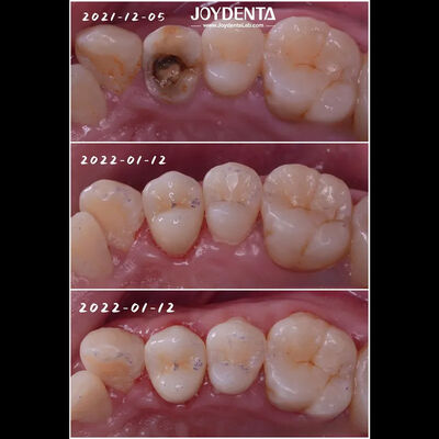 kopen Precise Fit Tandheelkundig Porselein Inlay Beschadigde tanden Herstel online vervaardiging