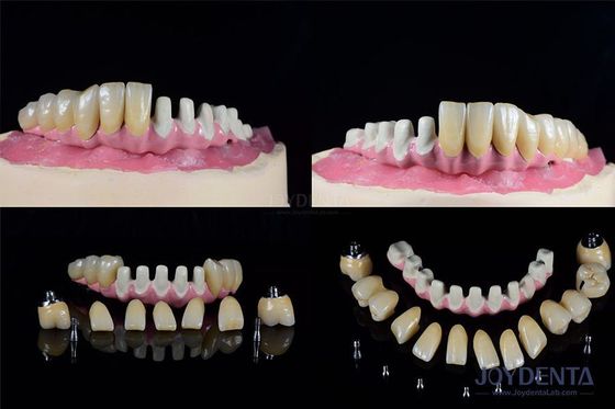 Meerdere endosese tandheelkundige implantaten Interne verbinding voor volledige boogherstel
