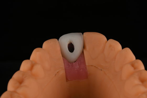 Titaan tandheelkundige implantaten met ruw oppervlak Operatie voor het vervangen van een voortand