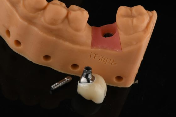 Precision Cylindrisch zilver enkel tandvervangend Implantaten Tandherstel