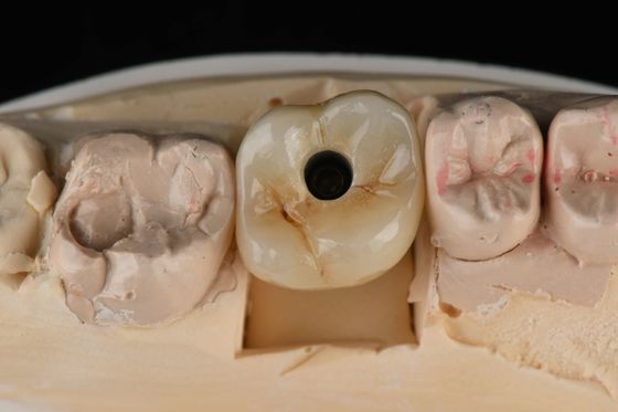 Titanium 10mm Eéntand Implantaten Vervanging van de onderkant Zelfklapend Zandgeblazen