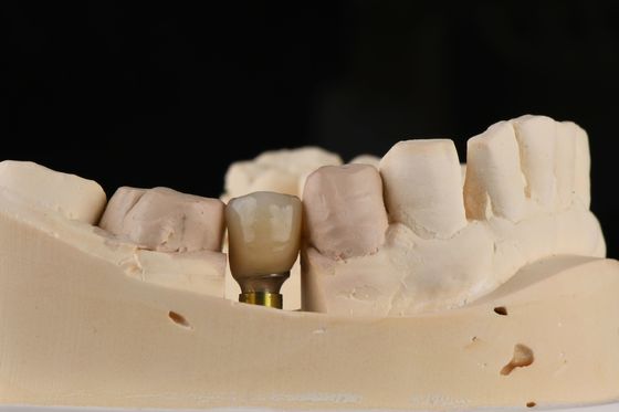 Zandgeblazen enkel tandimplantat met zelfklapend draad en interne hexverbinding