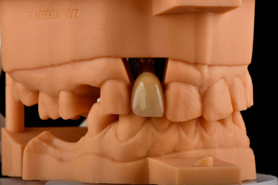 Interne Hex 3,0 mm Diepte 1,5 mm Pitch Single Titanium tand Implantat Vervanging
