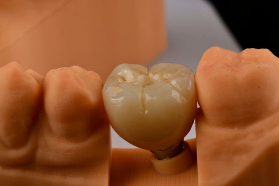 Oral Implantologie Zelftapende Eentand Implantaten Met Interne Hexverbinding