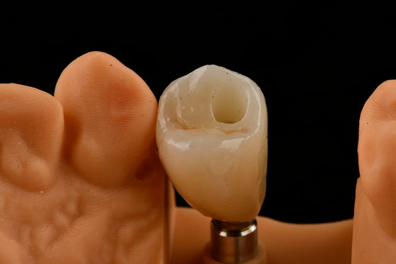 Titanium tandheelkundige implantaten met een enkele tand Interne hex-verbindingsvorm voor optimale pasvorm