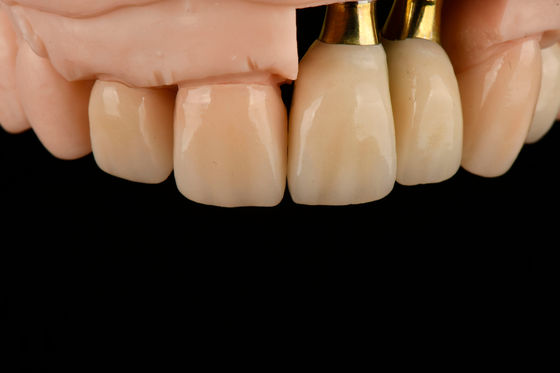 Titanium-sandblasted enkel tandvervangend implantaat met gamma-bestralingssterilisatie