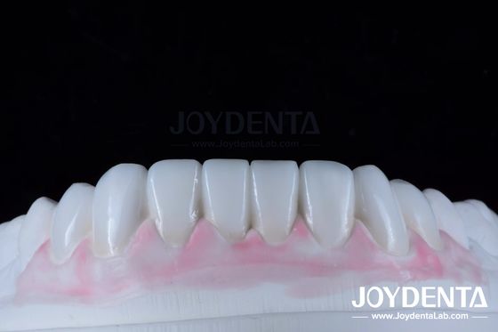 Op maat gemaakte digitale diagnostische wax-ups voor natuurlijke tandanatomie replicatie
