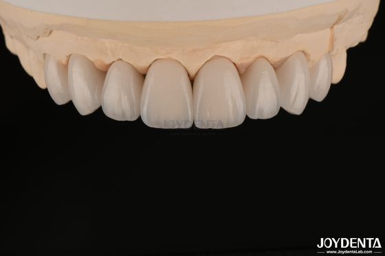 Soepel en lichtgewicht tandheelkundig veneers Biocompatibel en comfortabel voor de mondgezondheid