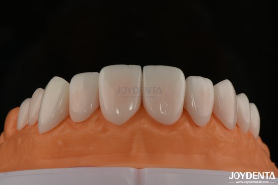 Optimaal patiëntcomfort met porseleinen fineer Biocompatibel en zacht op orale weefsels