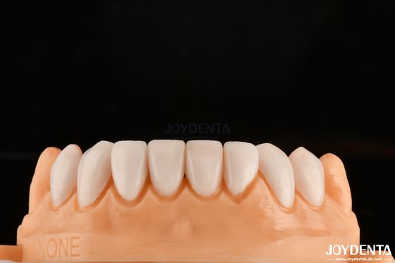 Sterke binding met tandglazuur voor veilige pasvorm tandheelkundige veneers Aanpassing voor gepersonaliseerde tinten om te matchen met natuurlijke tanden