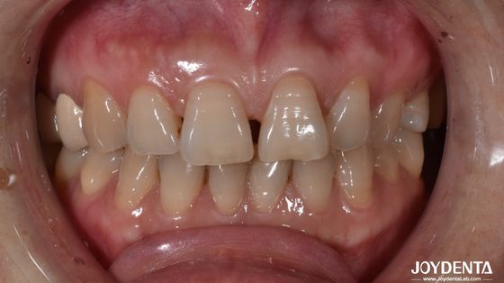 0.5 mm dikte keramische tandplaten natuurlijke op zoek naar voorgeet indicatie