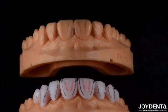 Op maat gemaakte tandheelkundige Emax keramische fineer met vlekwerende hoge glans