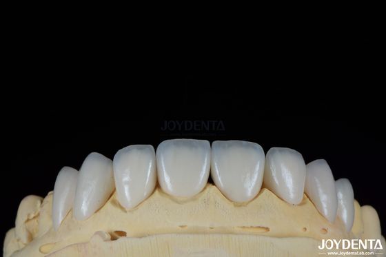 Glanzende oppervlakte Textuur Feldspatische fineer Natuurlijk uitziende porselein fineer