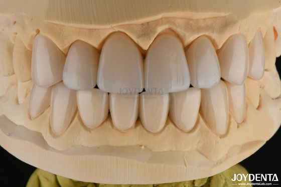 0.3-0.5mm Dikke Feldspatische Porseleinen Finer Hoog breukbestendigheid Verbeter je glimlach