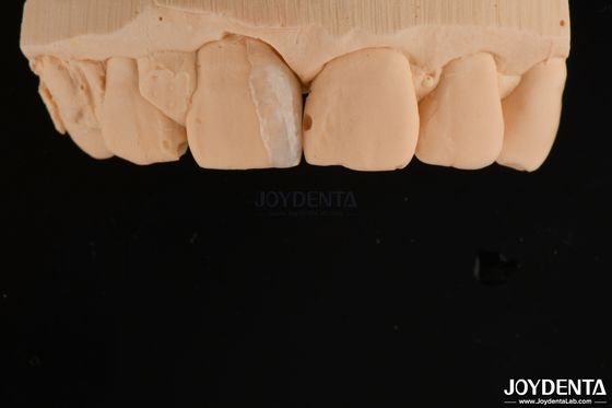 Kleine schil microfoelie Cosmetische tandheelkundige behandeling Kleine tandfoelie