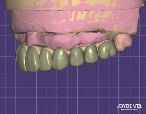 HIPAA-compliant Gegevensbeveiliging Digitaal Wax Up 3D-model voor tandheelkundige modificaties