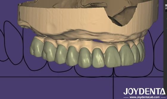 Gepersonaliseerd ontwerp Digitaal diagnostisch Wax Up Lab Software Naadloze integratie
