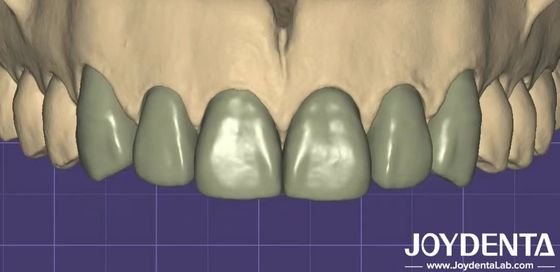 3D-printen Virtuele Digitale Wax Up Naadloze compatibiliteit met andere tandheelkundige software