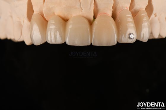 CAD / CAM frezen tandheelkundig gelaagd zirconia voor eenvoudige kronen 0,3-0,5 mm laagdikte