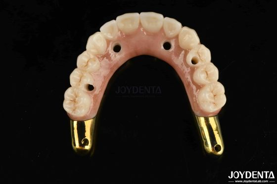slijtvast Zirconia Hybride brug met Ti-Bar Compatibele natuurlijke tanden en tandvlees