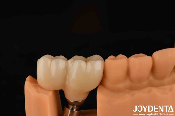V-vormige draadtype Afgewerkte abutments Compatibiliteit met alle belangrijke implantaatsystemen