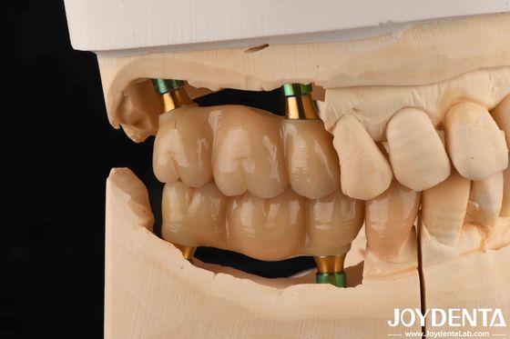 4.5 mm Hoogte Gepolijst Interne Hex Tandheelkundige Implantaten Abutments V-vorm Schroef behouden