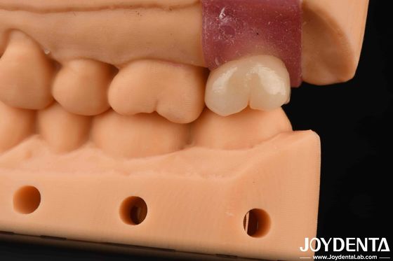 4.1mm V-vormige draad Titanium abutments met interne hex verbinding