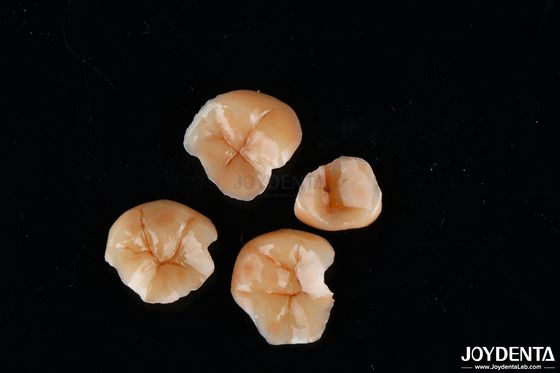 Aanpasbare vorm composiet inlays en onlays tandvlek weerstand langdurig
