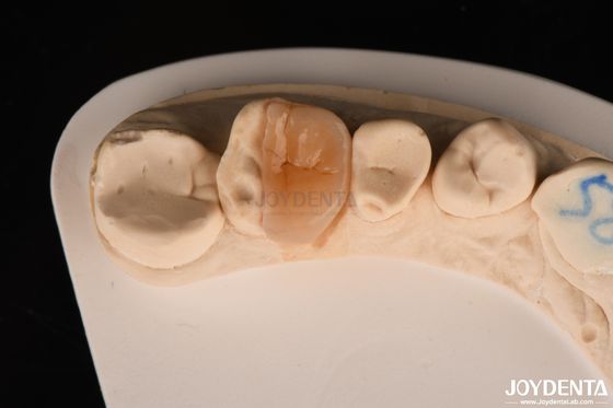 Zirconia-inlay Onlay met kleefcementering voor herstel van beschadigde tanden
