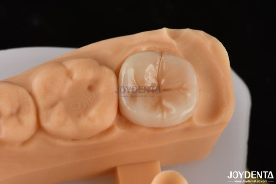 0.5mm-2mm Precise Fit Emax Dental Inlay Onlay voor betrouwbare tandherstel