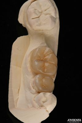 Emax Tandheelkundige Inlays En Onlays Breukbestendig 1,5 mm Lage doorzichtigheid