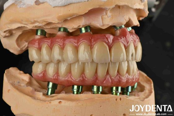 Hybride technologie Titanium Malong Tandbrug verstelbaar voor esthetische resultaten