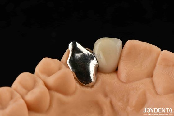 Aanpasbaar metalen materiaal PFM Maryland Tandheelkundige zorg Orale klinische reparatie