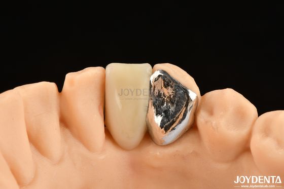 Ideale match Clinical Bonding Maryland Dental voor orale klinische reparatiewerkzaamheden