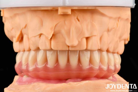 Natuurlijke acrylprothese met hoge biocompatibiliteit