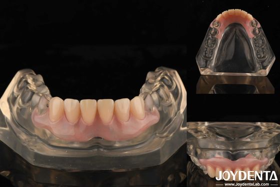 Tandopstelling Technologie Flexible Prothese Finish Hoge elasticiteit Aanpassing
