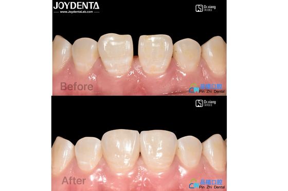 Veilig geschikt porseleinen veneers tandheelkundige behandeling composiet hars veneers vlekbestendig