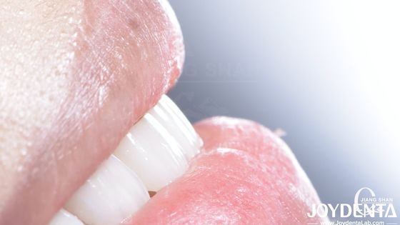 Langdurig tandheelkundig composiet veneer Goede biocompatibiliteit Geen afval van porselein veneers