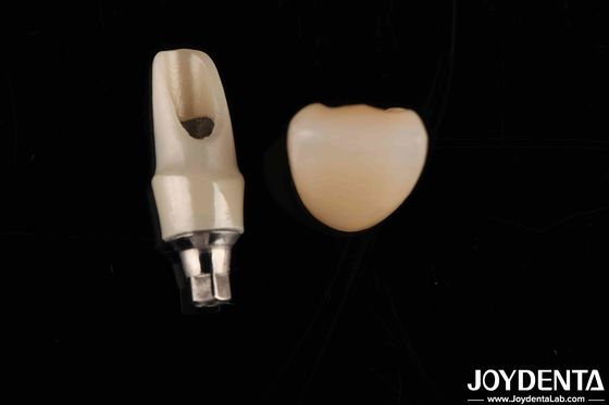 Zirconia Custom Abutments And Bars Tandheelkundige herstelwerk voor de individuele anatomie van de patiënt