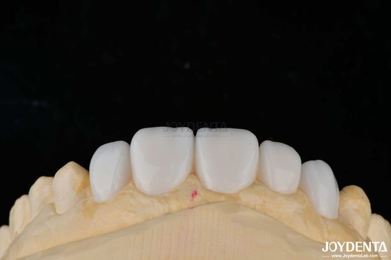 Aanpassing Porselein Materiaal Emax Tanden veneers voor hoge esthetiek binding
